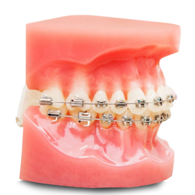 Braces in Mexico, affordable prices