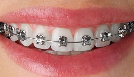 Metal braces in smile makeover