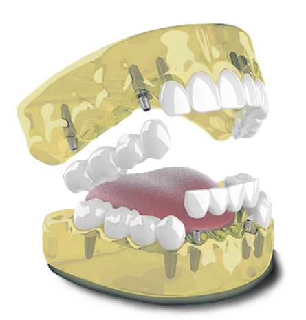 3 on 6 implants - Dental Bridge + Dental Implants - Smile Makeover Playa del Carmen