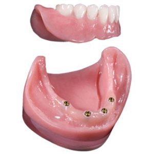 snap on dentures locator retained in mexico