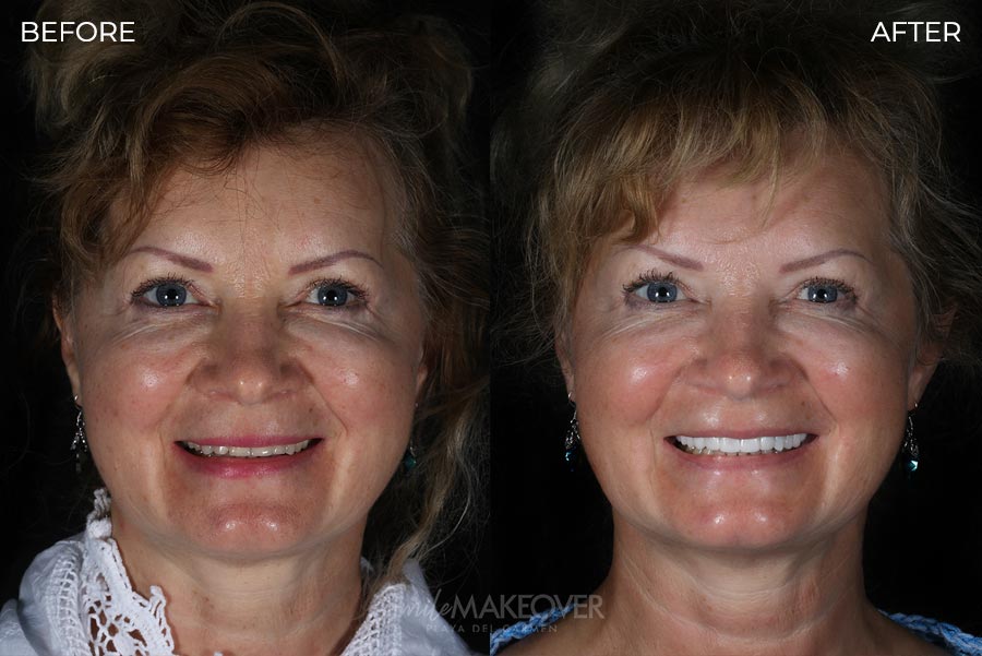 Before and after dental veneers in Mexico