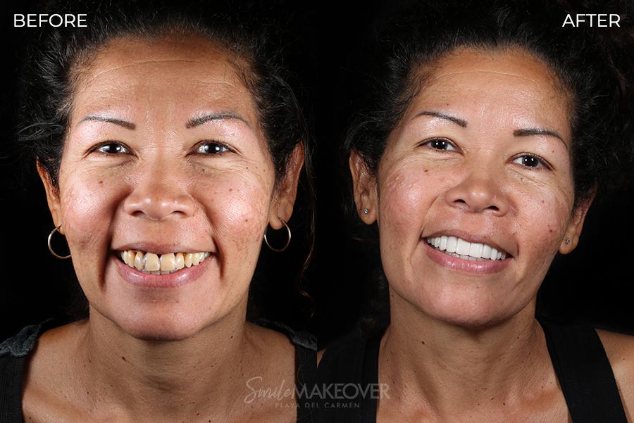 Before & After of Dental Veneers in mexico