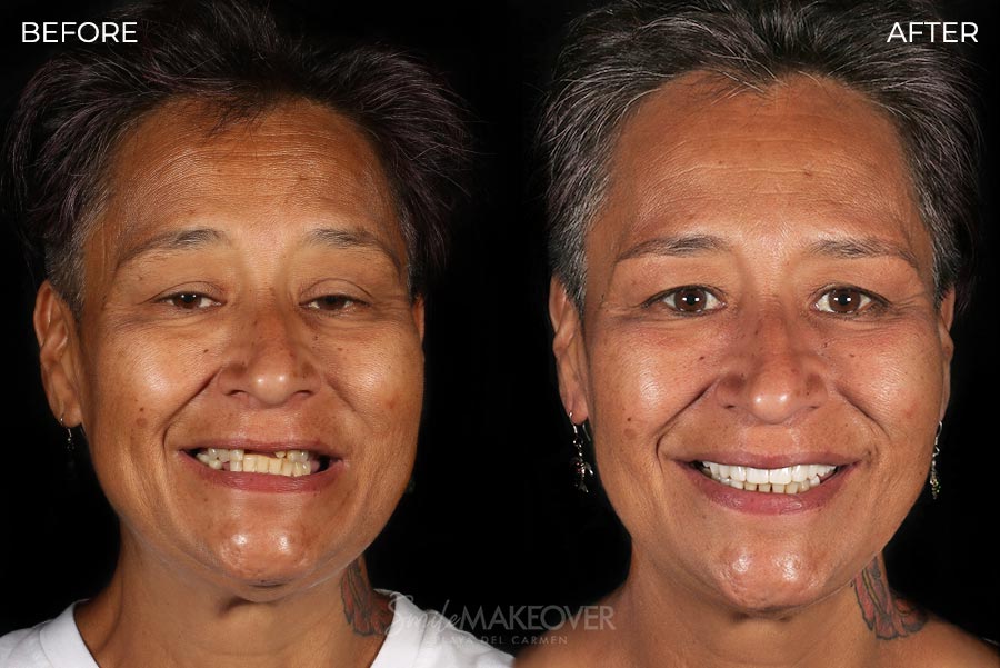 Before and after mouth restoration in Mexico
