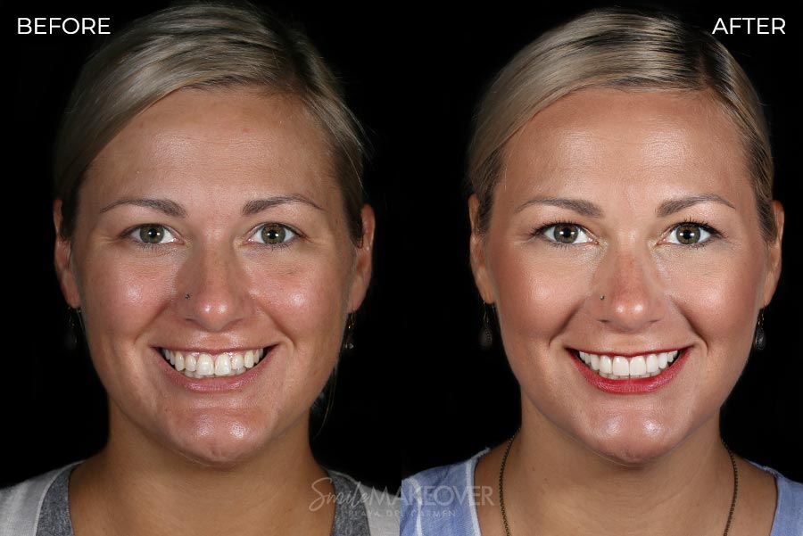 Before & After Dental Veneers in Mexico