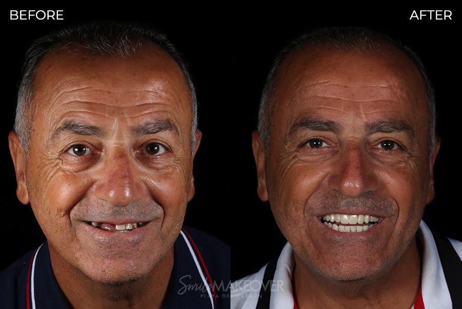 Before & After dental implants