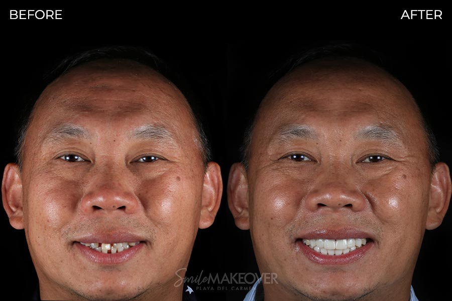 before & after dental veneers