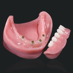 Specialists in Snap-on Dentures in Mexico - Dentist in Playa del Carmen