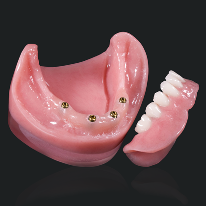 snap on dentures in mexico