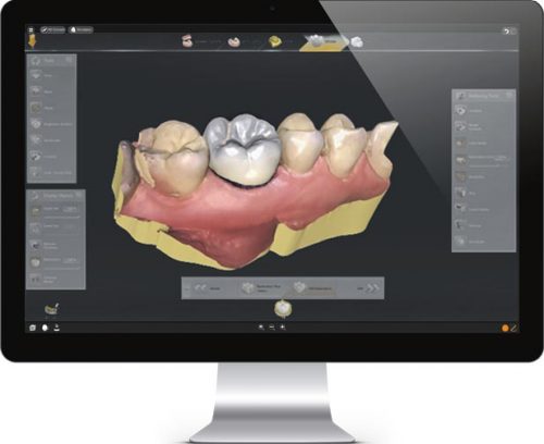 smile design with dental crowns mexico